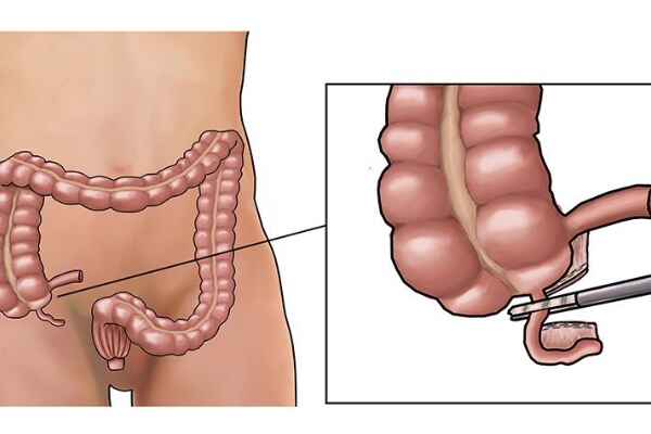 Understanding Appendix Surgery: What You Need to Know